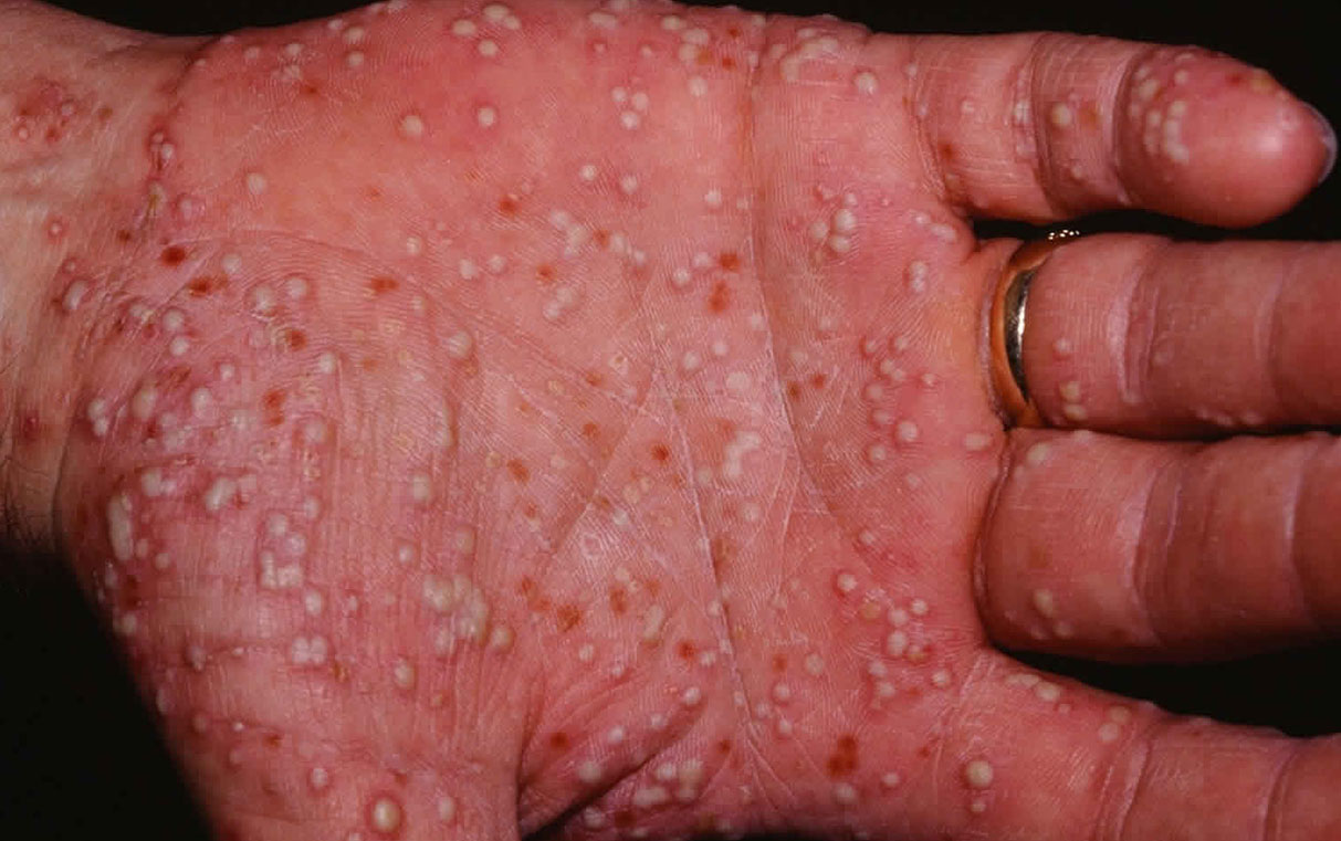 Palmoplantar pustular