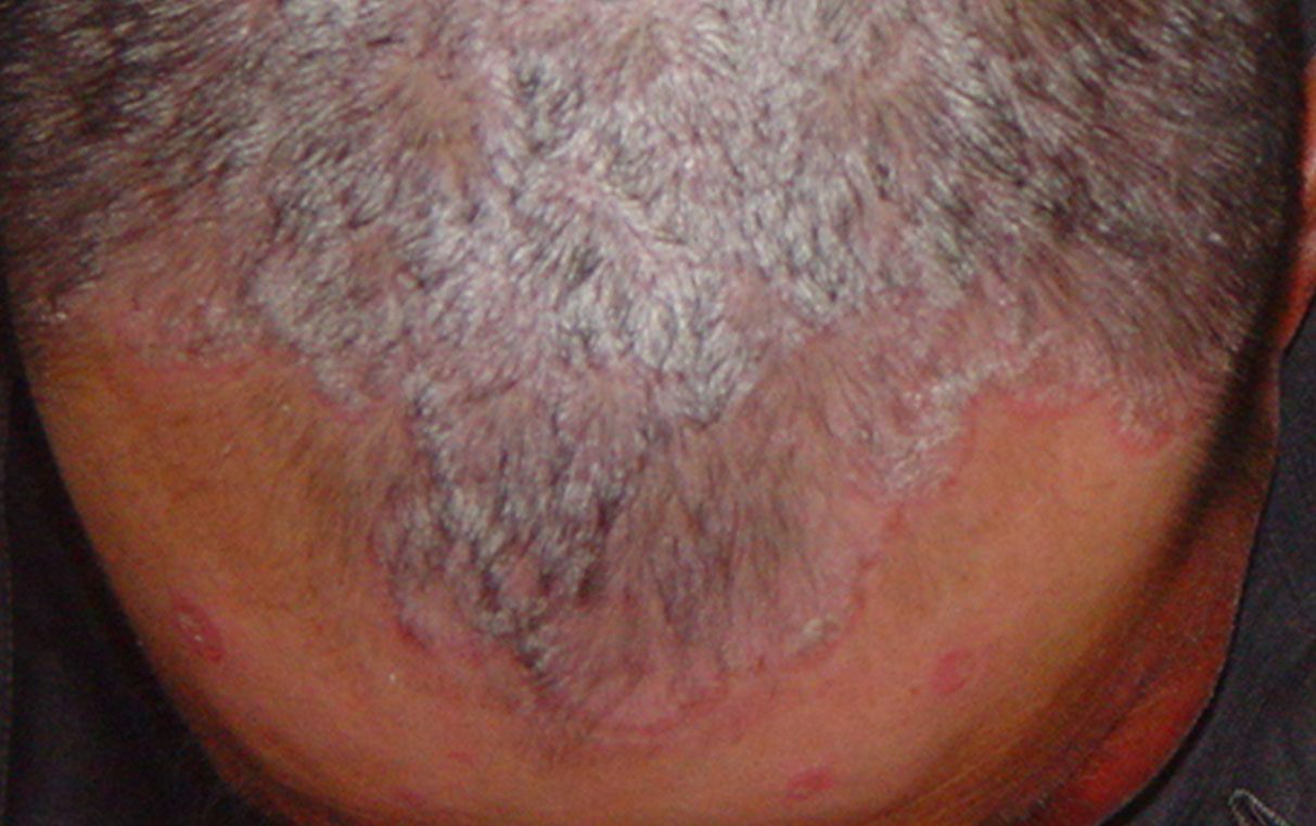 Sebopsoriasis Plaque